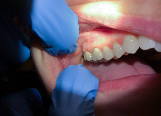 Best Emergency Care for Gum Disease in Lees Summit, MO